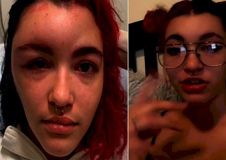 Mulher pinta o cabelo e fica com rosto deformado com reação alérgica
