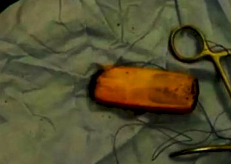 Homem engole celular, não consegue evacuar e acaba na mesa de cirurgia