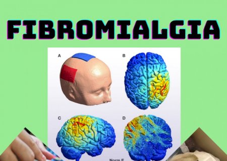 Fibromialgia: o que é, sintomas, diagnósticos e tratamentos