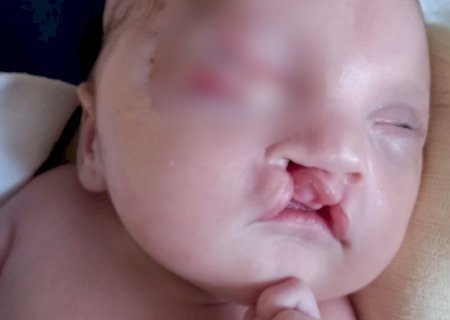 Com risco de ficar cego, família de Apolo faz apelo para custear viagem para cirurgias em SP