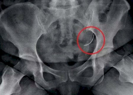 Paciente convive h&aacute; 35 anos com agulha, esquecida 2 vezes dentro do corpo dela