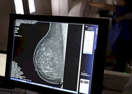Cerca de 77 mil mulheres aguardam mamografia pelo SUS