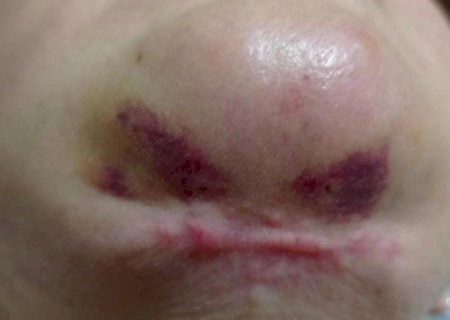 Dourados - Clínica e dentistas são condenadas após cirurgias estéticas deformarem rosto em MS