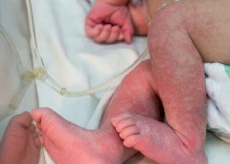 Em 24h, Dourados tem sessenta novos casos confirmados de chikungunya