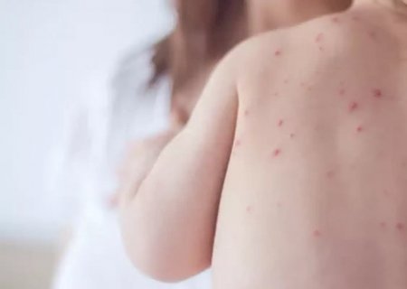 Estado de São Paulo reforça necessidade de vacinação contra o sarampo