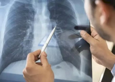 Anvisa aprova medicamento inovador para tratamento de câncer de pulmão avançado